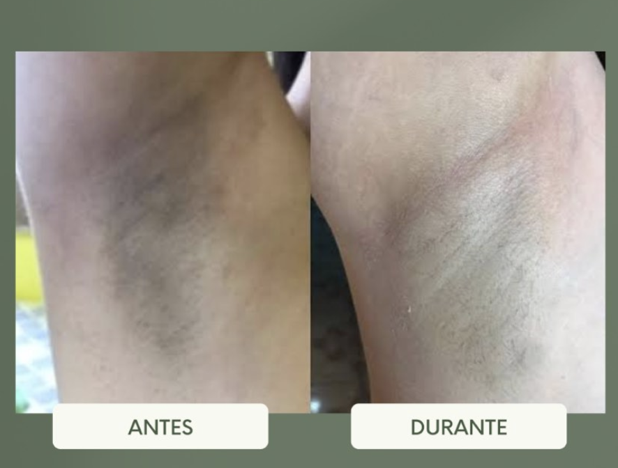 Depilação LED/LASER